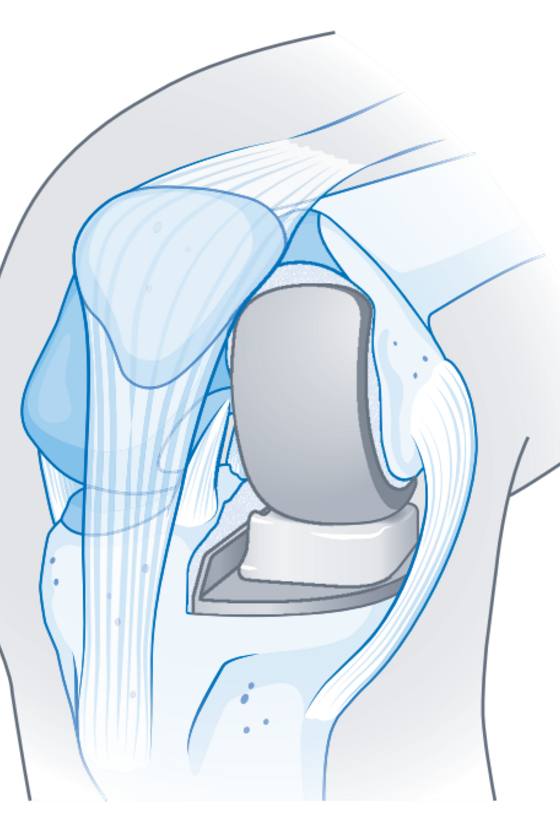 Illustration einer Schlittenprothese für ein künstliches Kniegelenk aus dem Leistungsspektrum im Albertinen Endoprothetikzentrum Hamburg Illustration einer Schlittenprothese für ein künstliches Kniegelenk aus dem Leistungsspektrum im Albertinen Endoprothetikzentrum Hamburg