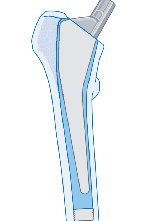 Grafische Darstellung einer vollzementierten Kurzschaftprothese für ein künstliches Hüftgelenk aus dem Leistungsspektrum im Albertinen Endoprothetikzentrum in Hamburg Grafische Darstellung einer vollzementierten Kurzschaftprothese für ein künstliches Hüftgelenk aus dem Leistungsspektrum im Albertinen Endoprothetikzentrum in Hamburg