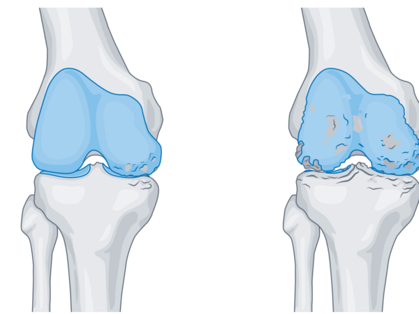 Grafische Darstellung eines Kniegelenks mit Prothesenteil mit Knorpelschäden und verengtem Gelenkspalt im Albertinen Endoprothetikzentrum Hamburg Grafische Darstellung eines Kniegelenks mit Prothesenteil mit Knorpelschäden und verengtem Gelenkspalt im Albertinen Endoprothetikzentrum Hamburg